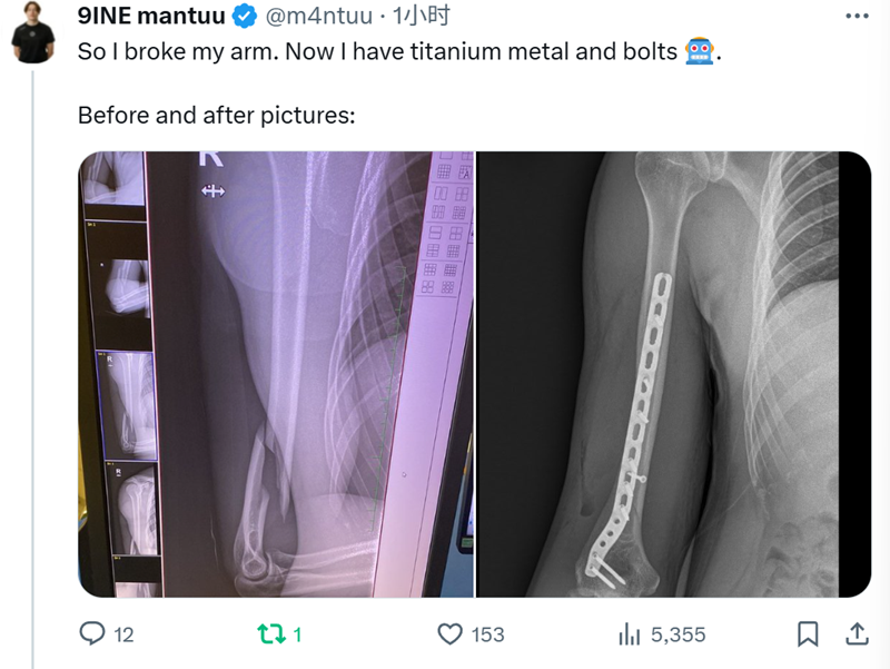运气不佳mantuu胳膊骨折